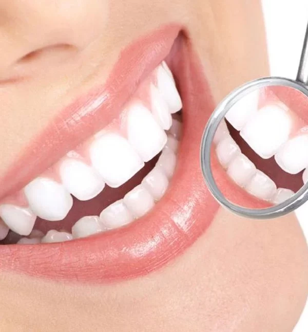 لمینت ips دندان :مزایا، کاربرد و مراقبت های بعد از آن