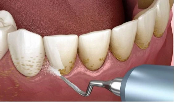 جرم گیری دندان چیست؟ معایب و مزایای آن