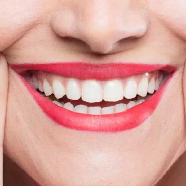 نکات مهم در خصوص اصلاح طرح لبخند