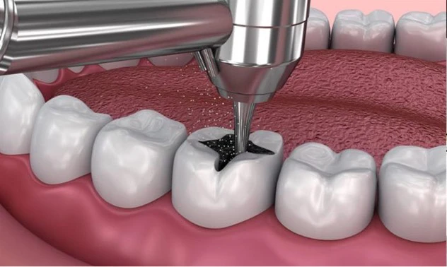 روش های مختلف ترمیم دندان
