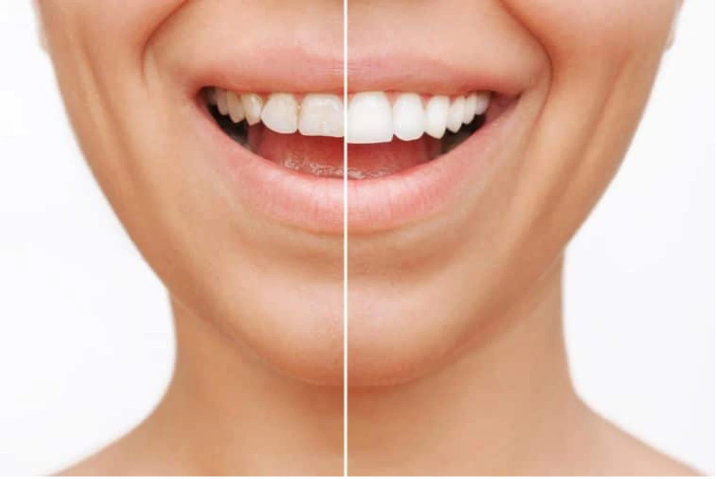 مراقبت های بعد از لمینت دندان به توصیه دندانپزشکان