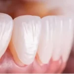 طول عمر لمینت دندان چقدر است؟
