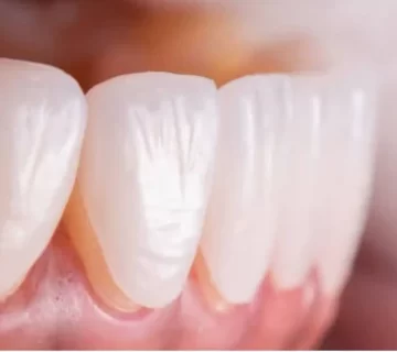 طول عمر لمینت دندان چقدر است؟