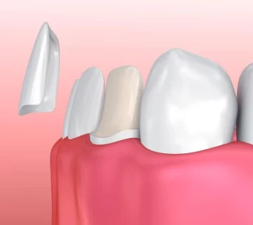 انواع لمینت دندان و مزایای آن ها