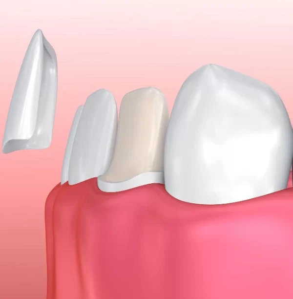 انواع لمینت دندان و مزایای آن ها