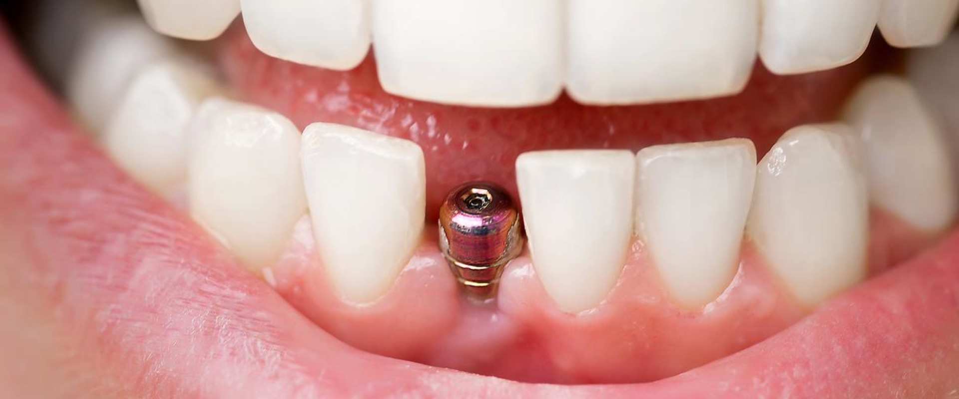 مزایا و معایب ایمپلنت های دندانی یک روزه | آیا برای من مناسب است؟